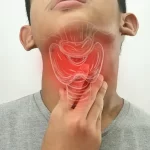 લેરીન્જાઇટિસ