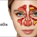 સાઇનસાઇટિસ