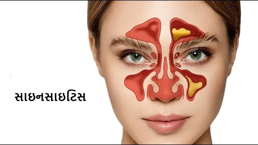 સાઇનસાઇટિસ