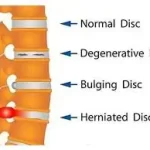 હર્નિએટેડ ડિસ્ક (Herniated Disc)