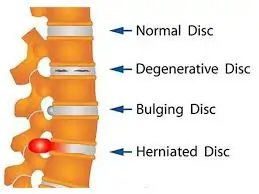હર્નિએટેડ ડિસ્ક (Herniated Disc)