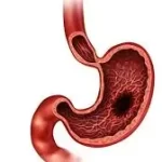 અલ્સર (Ulcer)