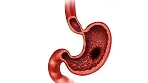 અલ્સર (Ulcer)