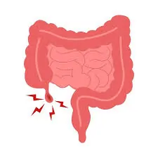 એપેન્ડિસાઈટિસ (Appendicitis)