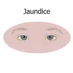 કમળો (Jaundice)
