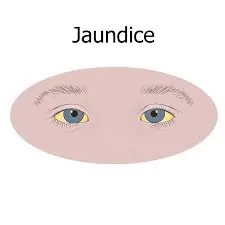 કમળો (Jaundice)
