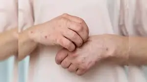 ખોરાકની એલર્જી (Food Allergy)