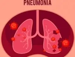 ન્યુમોનિયા (Pneumonia)