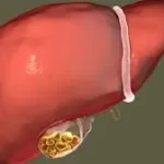 પથરી (પિત્તાશયની) (Gallstones)
