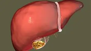 પથરી (પિત્તાશયની) (Gallstones)