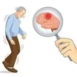 પાર્કિન્સન (Parkinson’s)