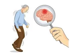 પાર્કિન્સન (Parkinson’s)