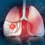 ફેફસાનું કેન્સર (Lung Cancer)