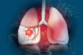 ફેફસાનું કેન્સર (Lung Cancer)