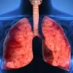 ફેફસામાં પાણી ભરાવું (Pleural Effusion)