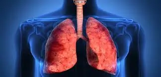ફેફસામાં પાણી ભરાવું (Pleural Effusion)