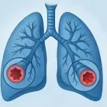 બ્રોન્કાઈટિસ (Bronchitis)