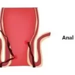 ભગંદર (Fistula)