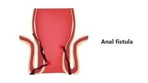 ભગંદર (Fistula)