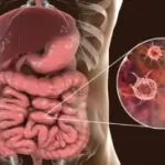 મરડો (Dysentery)