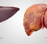 લિવર સિરોસિસ (Liver Cirrhosis)