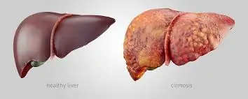 લિવર સિરોસિસ (Liver Cirrhosis)