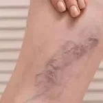 લોહી ગંઠાઈ જવું (Blood Clotting)