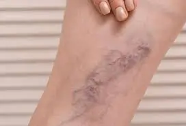 લોહી ગંઠાઈ જવું (Blood Clotting)