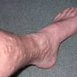 વેરિસોઝ વેઈન્સ (Varicose Veins)