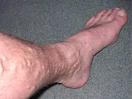 વેરિસોઝ વેઈન્સ (Varicose Veins)