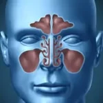 સાઈનસ (Sinusitis)