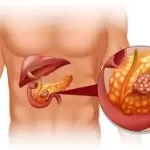 સ્વાદુપિંડનો સોજો (Pancreatitis)