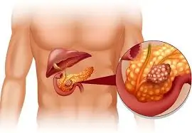 સ્વાદુપિંડનો સોજો (Pancreatitis)