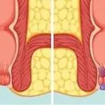 હરસ / મસા (Piles / Hemorrhoids)