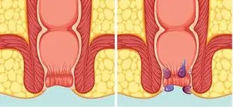 હરસ / મસા (Piles / Hemorrhoids)