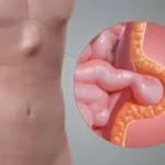 હર્નિયા (Hernia)