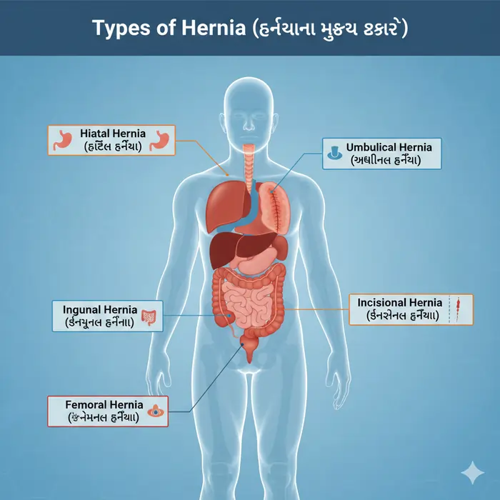 હર્નિયા એટલે શું