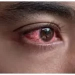 અંધાપો (Blindness)