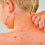 અછબડા (Chickenpox)