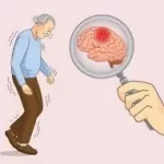 અલ્ઝાઈમર (Alzheimer’s Disease)