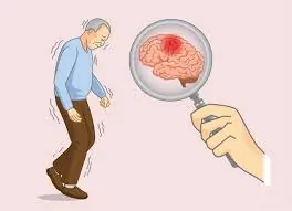 અલ્ઝાઈમર (Alzheimer’s Disease)