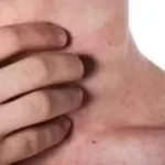 અળાઈ (Prickly Heat)