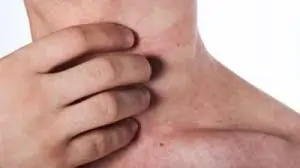 અળાઈ (Prickly Heat)