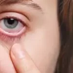 આંખ આવવી (Conjunctivitis)