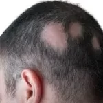 ઉંદરી (Alopecia Areata)