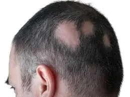 ઉંદરી (Alopecia Areata)