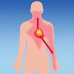 એન્જિના (Angina)