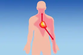 એન્જિના (Angina)