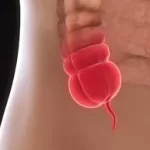 એપેન્ડિક્સ (Appendix)