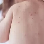 ઓરી (Measles)